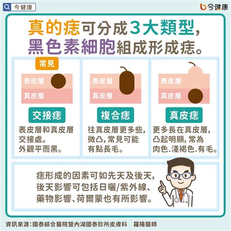 有問題的痣|是痣？皮膚癌？還是什麼？常見Q&A解惑！醫教揪出「。